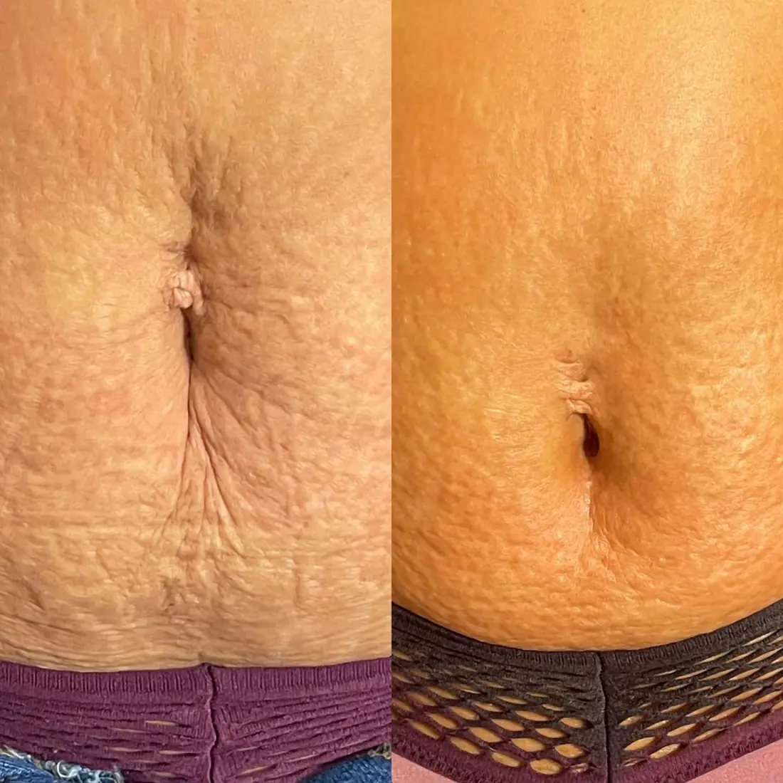 Radio Frequency (RF) Skin Tightening