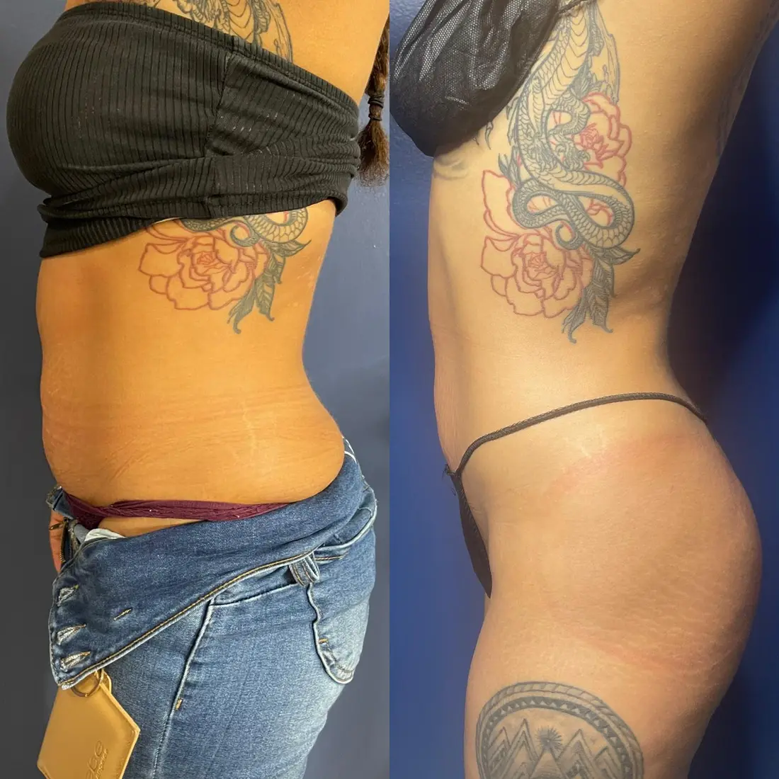 Ultrasonic Cavitation