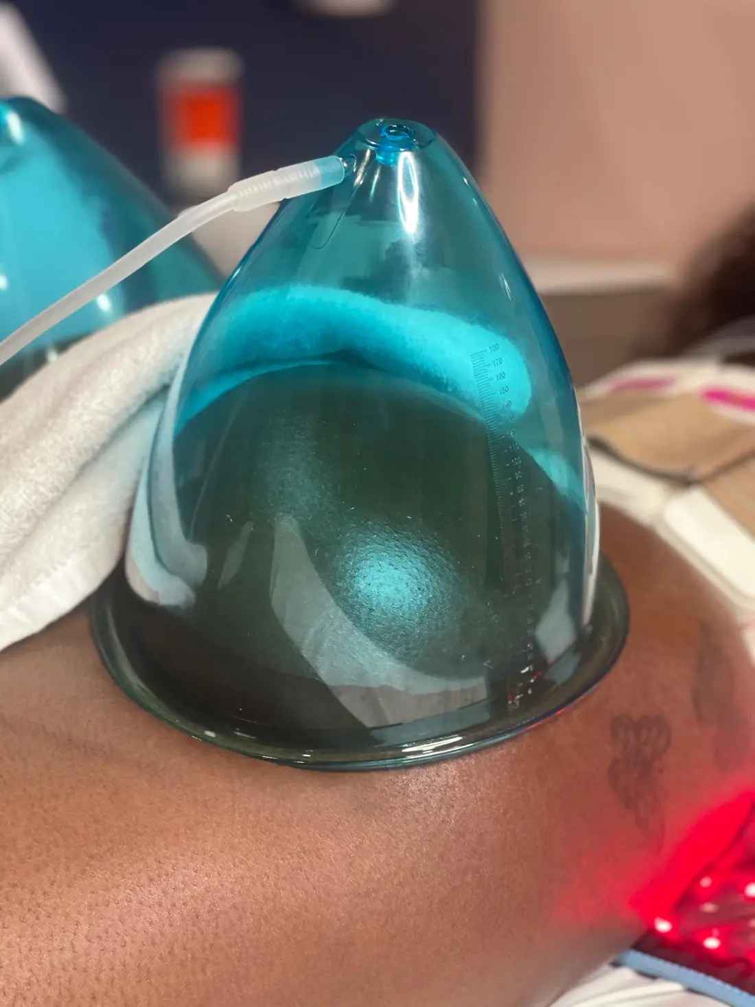 Vacuum Therapy (Butt Lift)